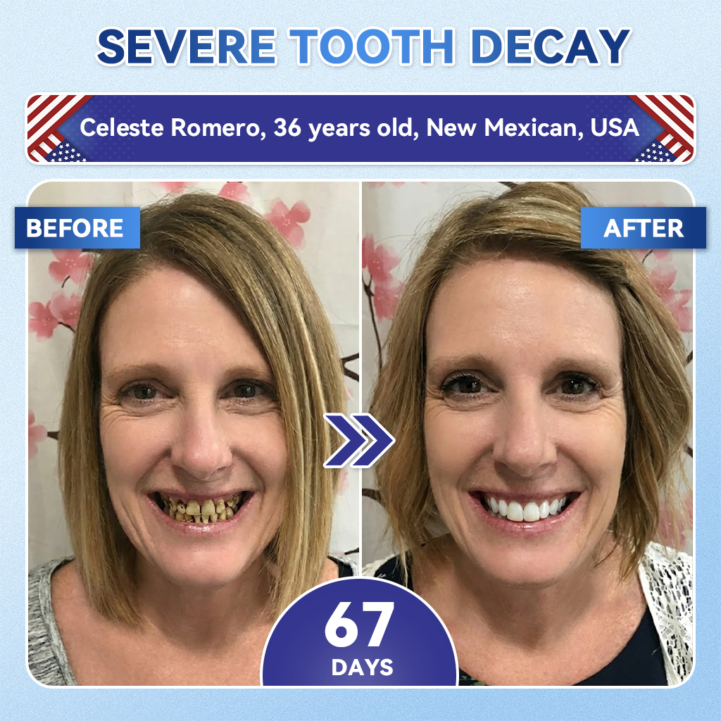 🦷𝑪𝒓𝒆𝒂𝒘𝒆𝒍® 𝐓𝐢𝐝𝐞𝐠𝐥𝐮𝐬𝐢𝐛 𝐓𝐨𝐨𝐭𝐡 & 𝐆𝐮𝐦 𝐑𝐞𝐩𝐚𝐢𝐫 𝐌𝐢𝐜𝐫𝐨𝐧𝐞𝐞𝐝𝐥𝐞 𝐏𝐚𝐭𝐜𝐡  | 𝐀𝐝𝐯𝐚𝐧𝐜𝐞𝐝 𝐒𝐭𝐞𝐦-𝐂𝐞𝐥𝐥 𝐀𝐜𝐭𝐢𝐯𝐚𝐭𝐢𝐨𝐧 𝐓𝐞𝐞𝐭𝐡 𝐒𝐭𝐫𝐢𝐩𝐬(🦷𝐑𝐞𝐛𝐮𝐢𝐥𝐝 𝐄𝐧𝐚𝐦𝐞𝐥 & 𝐃𝐞𝐧𝐭𝐢𝐧 • 𝐒𝐭𝐫𝐞𝐧𝐠𝐭𝐡𝐞𝐧 𝐆𝐮𝐦𝐬 • 𝐄𝐫𝐚𝐝𝐢𝐜𝐚𝐭𝐞 𝐓𝐚𝐫𝐭𝐚𝐫 & 𝐎𝐝𝐨𝐫 • 𝐒𝐭𝐨𝐩 𝐓𝐨𝐨𝐭𝐡 𝐒𝐞𝐧𝐬𝐢𝐭𝐢𝐯𝐢𝐭𝐲)😈